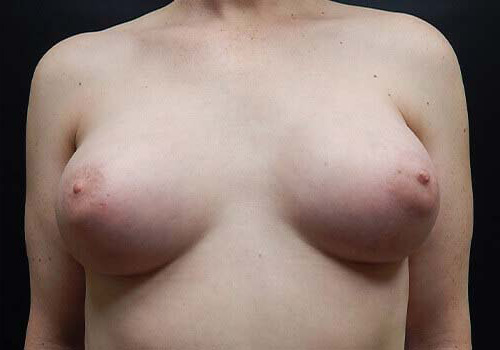 Breast Augmentation Patient After - 1