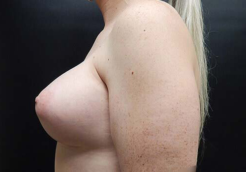 Breast Augmentation Patient After - 2
