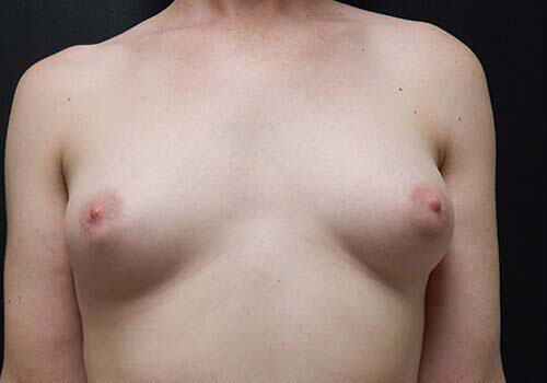 Breast Augmentation Patient Before - 1