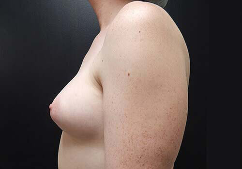 Breast Augmentation Patient Before - 2