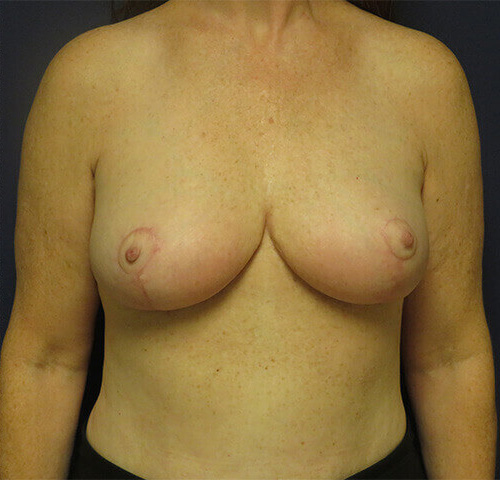 Breast Reduction Patient After - 1