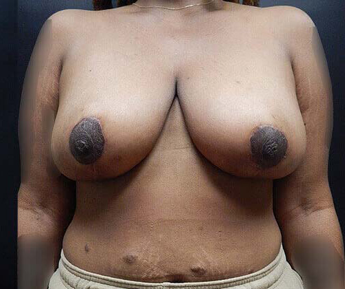 Breast Lift (Mastopexy) Patient After - 1
