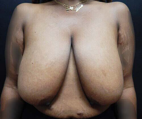 Breast Lift (Mastopexy) Patient Before - 1