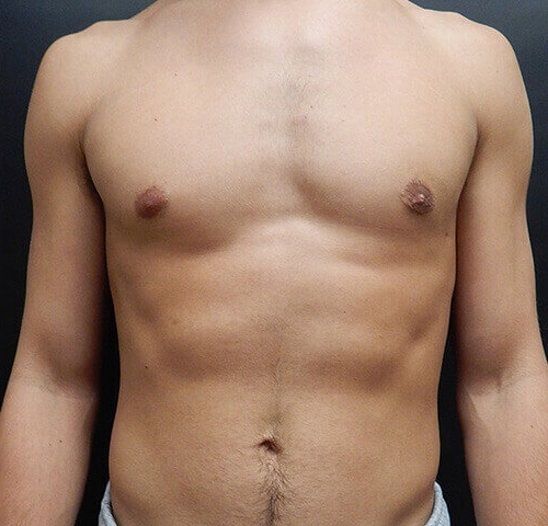 Male Breast Reduction (Gynecomastia) Patient After - 1