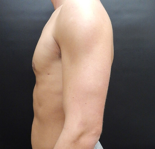 Male Breast Reduction (Gynecomastia) Patient After - 2