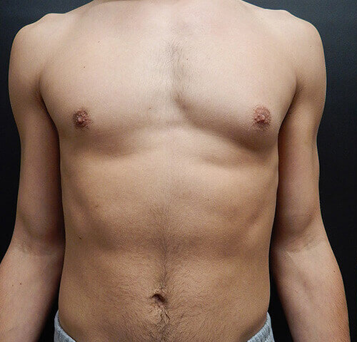 Male Breast Reduction (Gynecomastia) Patient Before - 1