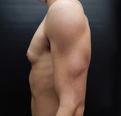 Male Breast Reduction (Gynecomastia) Patient Before - 2