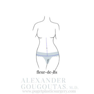 Fleur-de-Lis Tummy Tuck Graphic