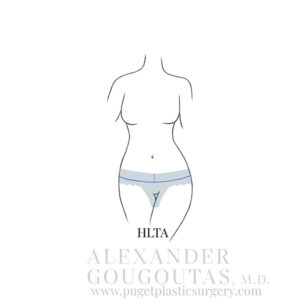 HLTA Tummy Tuck Graphic