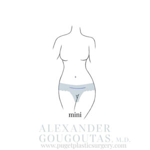 Mini Tummy Tuck Graphic