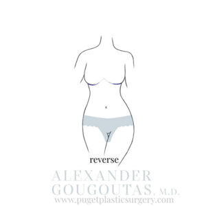Reverse Tummy Tuck Graphic