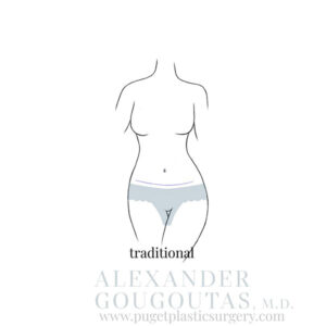 Traditional Tummy Tuck Graphic