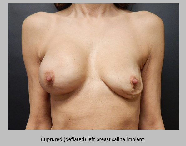 Ruptured saline implant