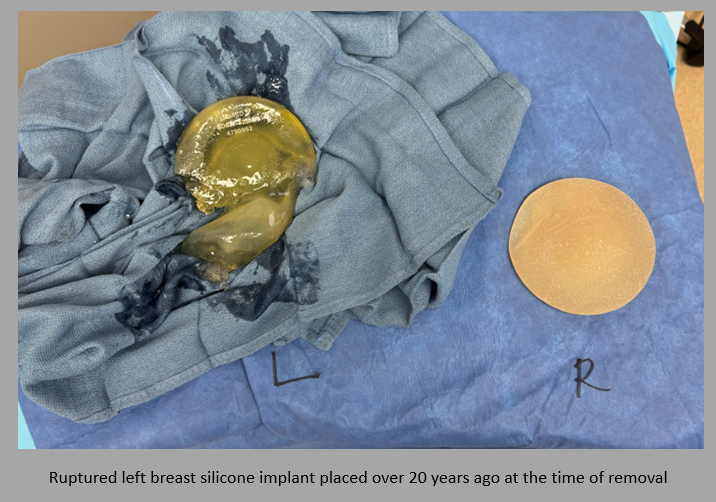 Ruptured implant after removal