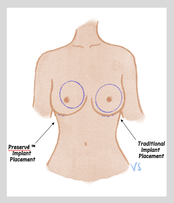Preserve vs Traditional implants