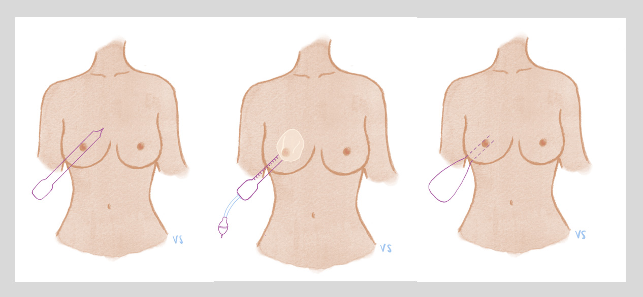 Breast inflation steps 