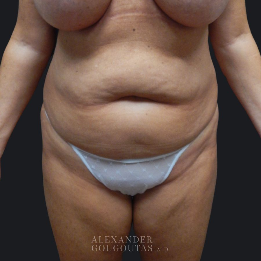 Case--4394 | Before Tummy Tuck 1