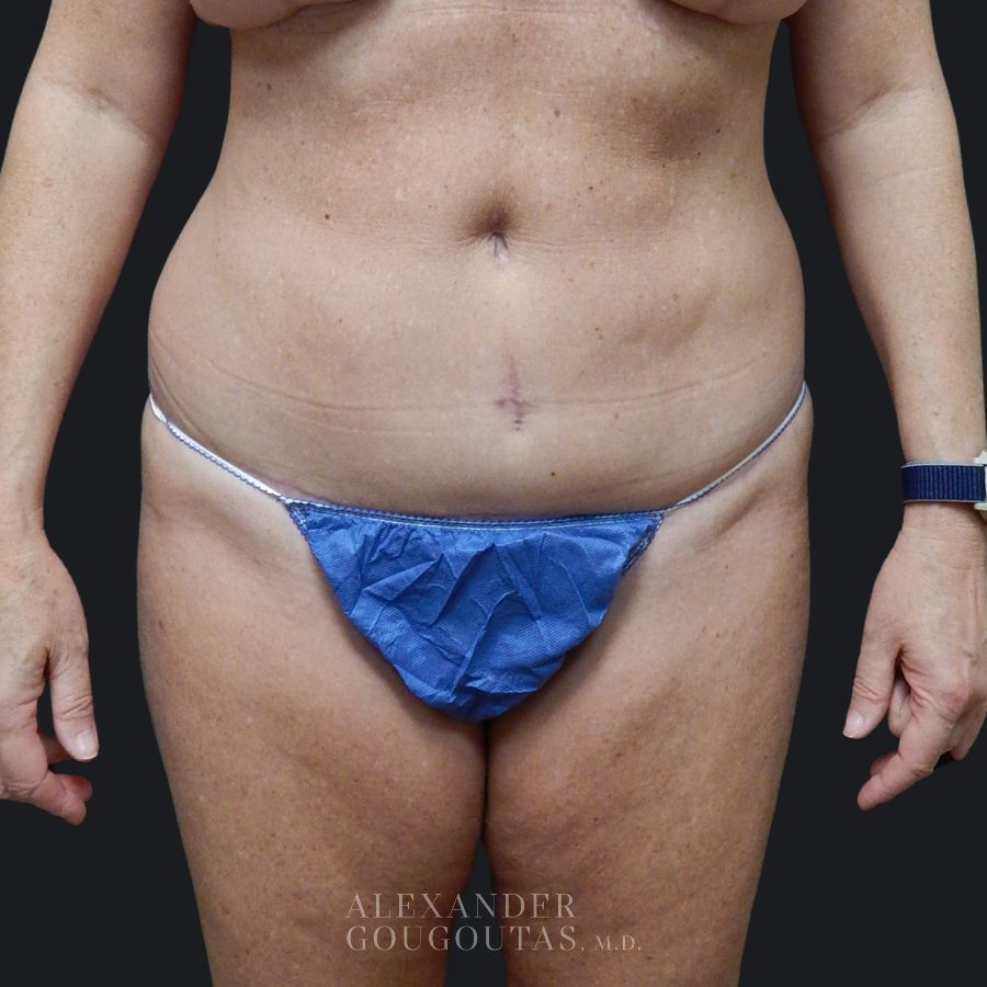 Case--4394 | After Tummy Tuck 1