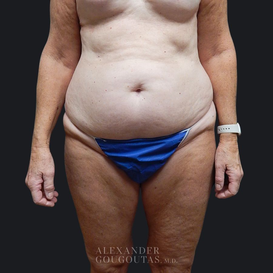 Case--8195 | Before Tummy Tuck 1