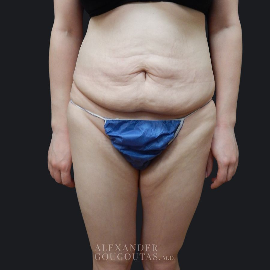 Case--4129 | Before Tummy Tuck 1