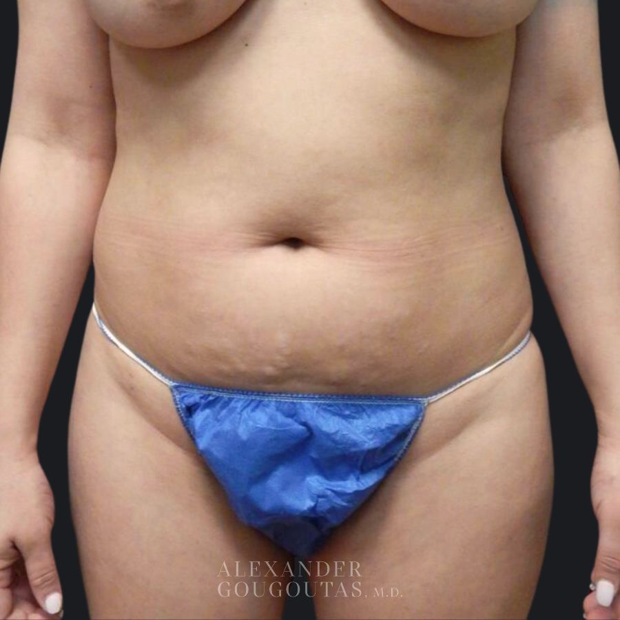 Case--8279 | Before Tummy Tuck 2