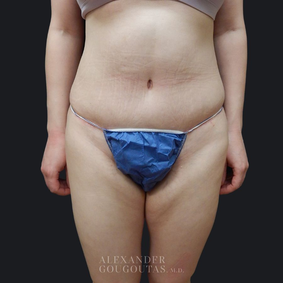 Case--4129 | After Tummy Tuck 1