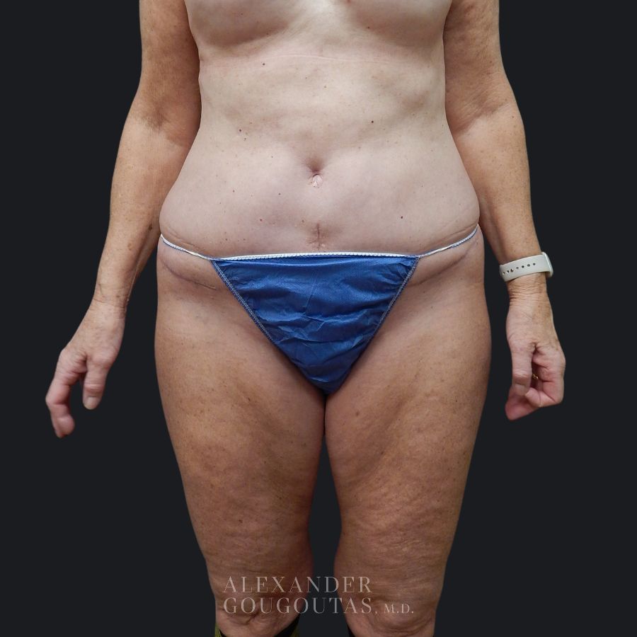 Case--8195 | After Tummy Tuck 1